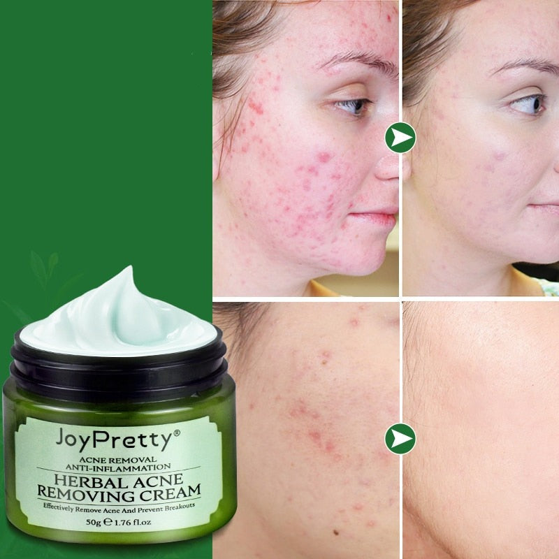 Acne creme facial joy pretty